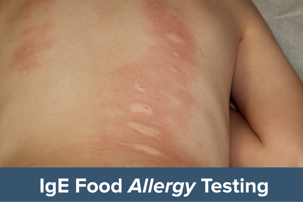IgE Food Allergy Testing