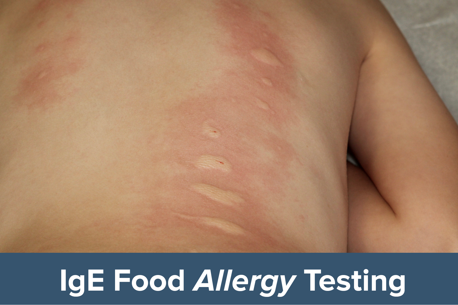 Taca Ige Food Allergy Testing The Autism Community In Action Taca