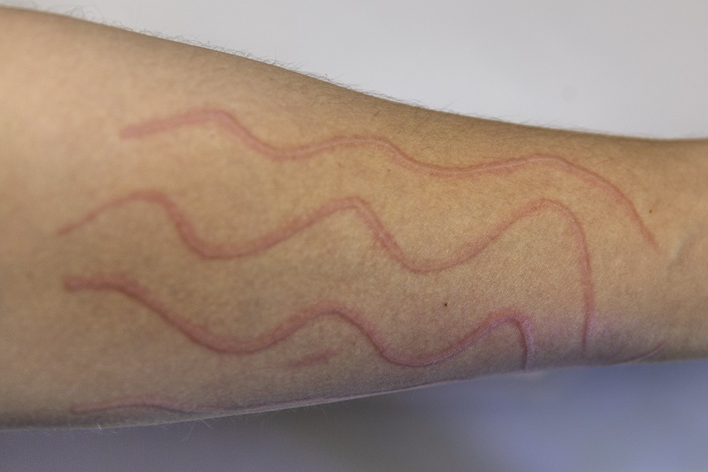 Close-up of a person's arm with dermatographia. This occurs when mast cells in the skin respond to pressure.