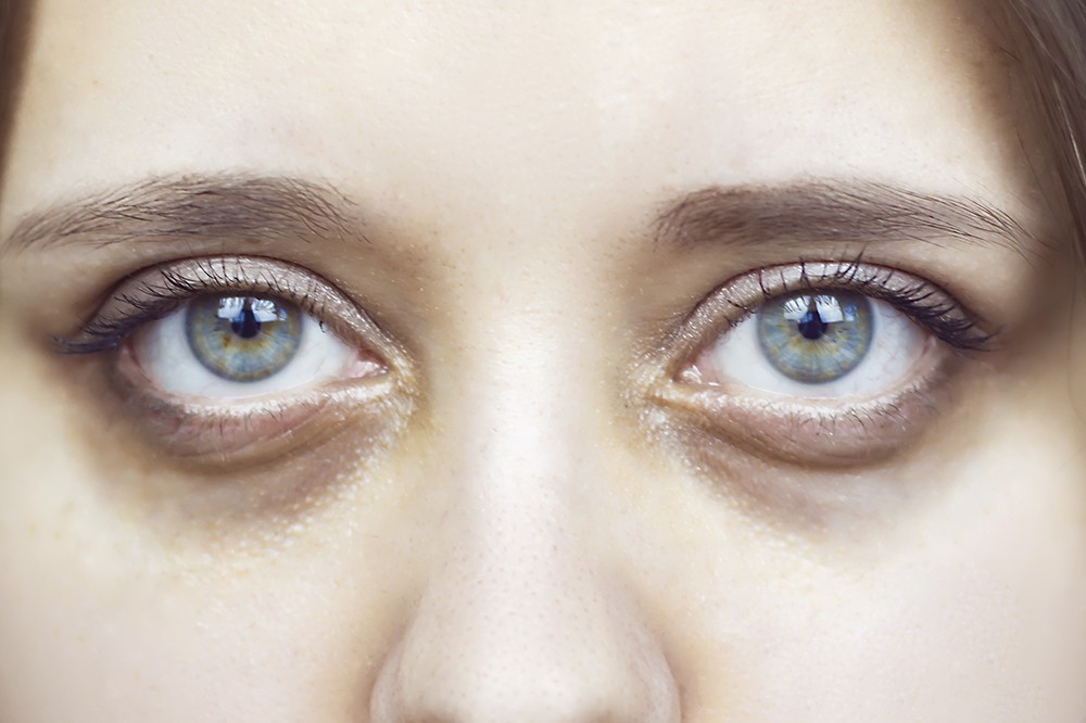 Close-up of a person's eyes with dark circles. Mast cells are one reason for dark circles around the eyes.